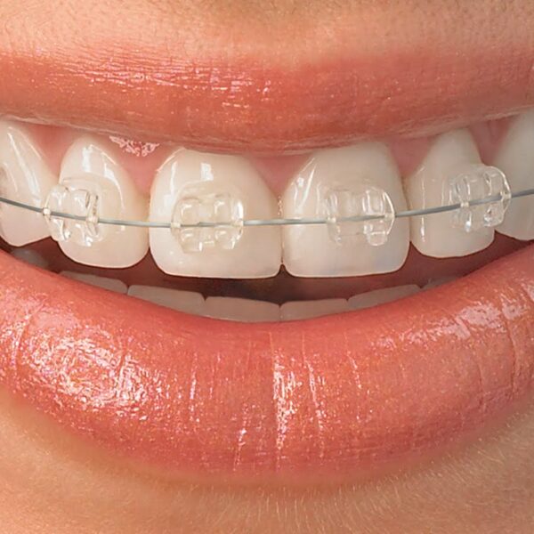 straighten-teeth-with-ICE-ceramic-braces2 (1)